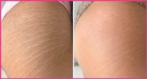 Sérum Multirreparador Beleza10 em protocolo profissional para estrias